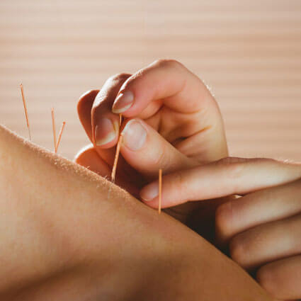 Acupuncture needles in shoulder